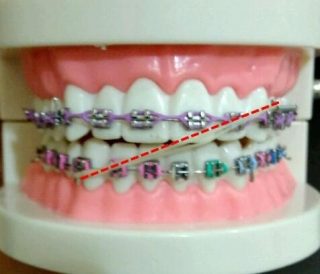 cross elastik gigi depan