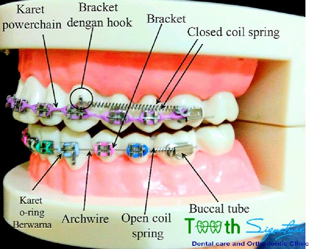 komponen-komponen dalam braces / behel / kawat gigi