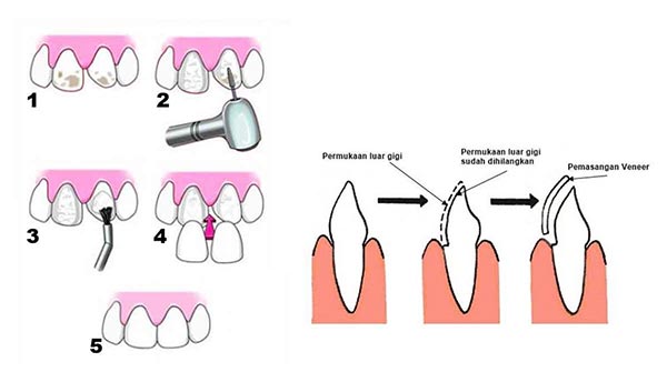 tahapan proses veneer gigi