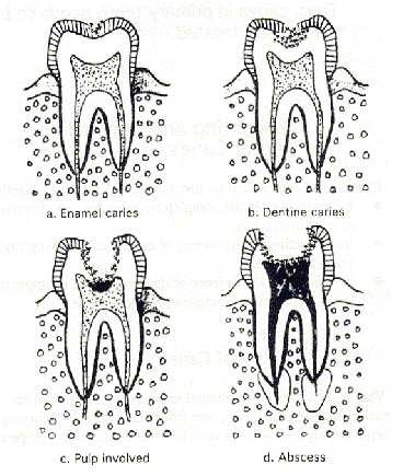proses terjadinya gigi berlubang