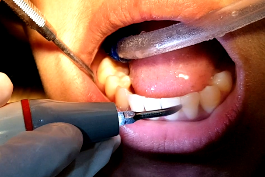 proses scaling gigi