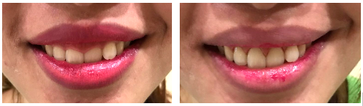 Foto sebelum dan sesudah gingivektomi. Gambar kanan adalah sesaat sesudah prosedur gingivektomi, terlihat perdarahan gusi sangat minimal. (source: dokumentasi Tooth Signature Dental)
