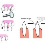 tahapan proses veneer gigi