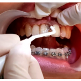 pemotongan gusi (source: dokumentasi tooth signature)