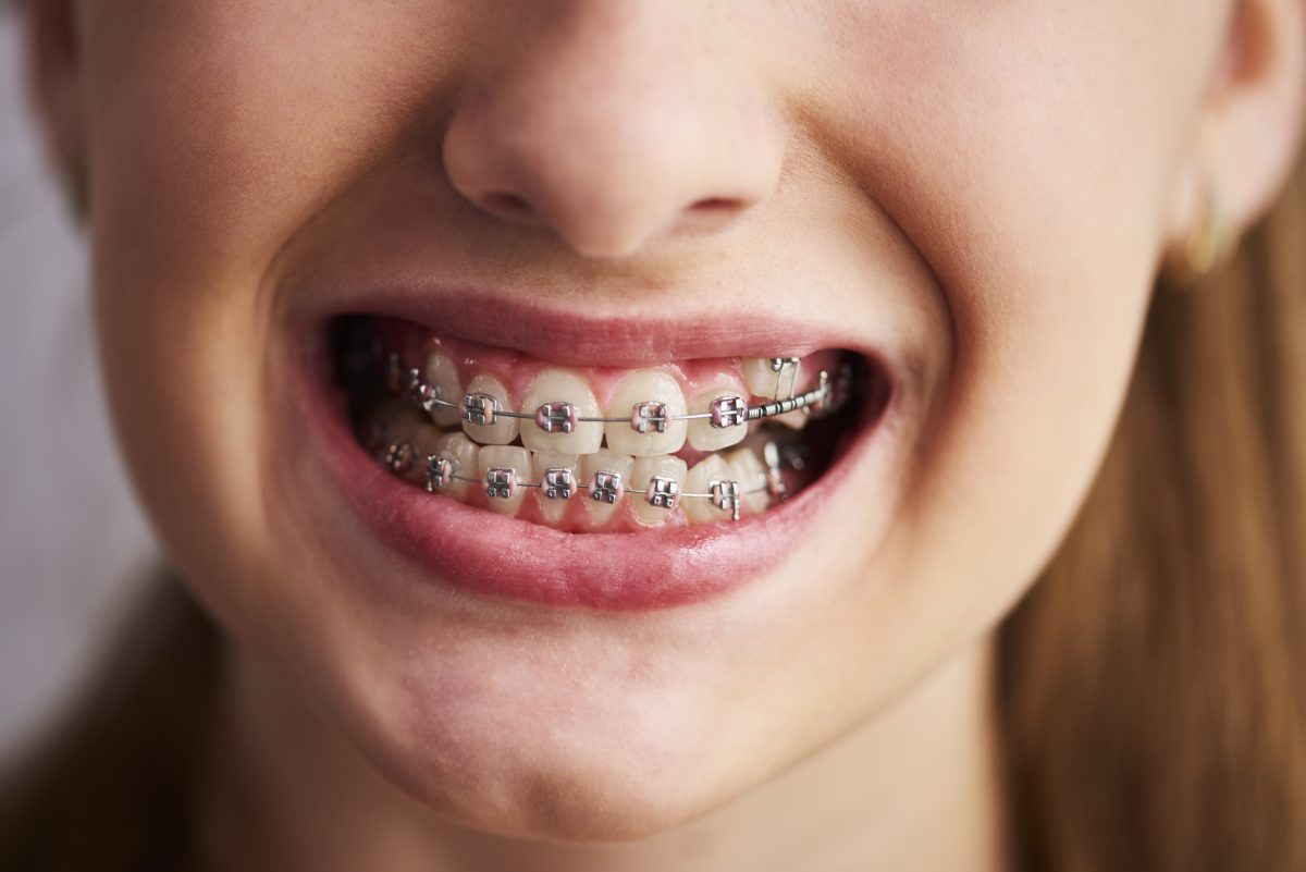 shot-teeth-with-braces-1200x801.jpg
