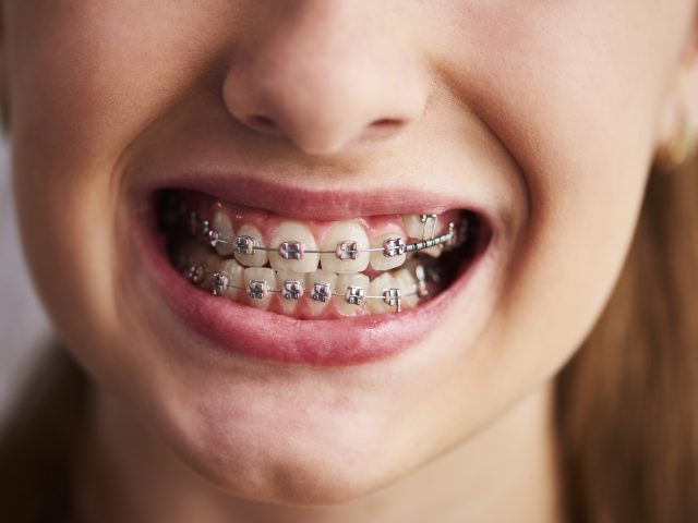 https://www.toothsignature.com/wp-content/uploads/2022/11/shot-teeth-with-braces-640x480.jpg